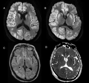 Brain MRI scan performed 48hours after admission showing hyperintensities on the diffusion-weighted (A and B) and FLAIR sequences (C), with diffusion restriction on ADC maps (D).