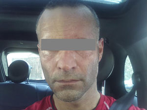 Photograph sent by the patient after exercise, showing anhidrosis and pallor on the right side of his face, ipsilateral to carotid artery dissection, and flushing and sweating on the left side.