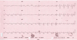 Sinus rhythm with first-degree atrioventricular block with ST-segment elevation of 1mm in V1-V3 with negative T wave in V1-V2, suggestive of type 1 Brugada pattern.