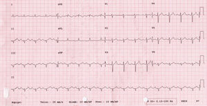 Normalisation of the previous electrocardiographic alterations.