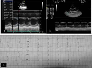 (A) Baseline echocardiography. (B) Echocardiography one year after onset of treatment with rhIGF-1: slight reductions are observed in the ventricular septum and in the diastolic diameter of the left ventricle. (C) Changes in repolarisation manifested as changes in T waves with no pathological Q waves.