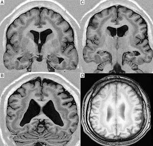 T1-weighted MR images (inversion recovery) obtained in a 1.5T scanner; coronal slices (A-C) and an axial slice (D) showing a band of grey matter within the subcortical white matter, with no lissencephaly or achygyria/pachygyria.
