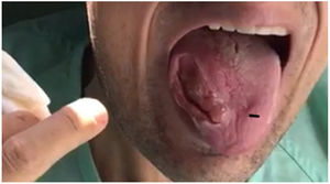 Lesion to the right edge of the tongue.