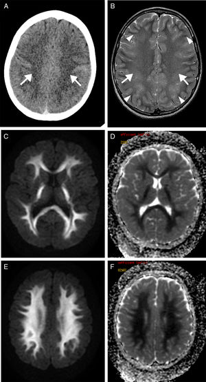 Transverse CT sequence (A) showing a faint hypodensity in the supratentorial white matter (arrows). Transverse T2-weighted MRI sequence (B) showing homogeneous hyperintensity of the supratentorial white matter, confluent with bilateral and symmetrical distribution (arrows), sparing the U fibres (arrowheads). Diffusion restriction is observed on the diffusion sequence (C and E) and corresponding apparent diffusion coefficient maps (D and F).