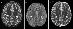 Follow-up MRI scan performed at 3 weeks. The transverse T2-weighted sequence (A) reveals normalised signal intensity in the white matter (arrows) and moderate loss of volume with more prominent sulci (arrowheads). Diffusion restriction (arrows) is no longer observed on the diffusion sequence (B) and corresponding apparent diffusion coefficient maps (C).