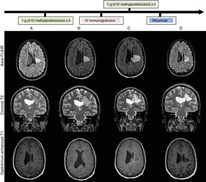 Brain MRI: lesion progression (FLAIR, T2-weighted, and gadolinium-enhanced T1-weighted sequences) at admission (A), after treatment with intravenous methylprednisolone (B), after treatment with intravenous immunoglobulins (C), and after treatment with rituximab (D). Heterogeneous lesion with grouped/confluent hypoechoic rims (A and B), progressing to cystic-malacic areas (C and D), affecting the left corona radiata and centrum semiovale with extension to the corpus callosum. Maximum diameter of 3cm at admission (A), increasing to 4.1cm despite treatment (C), and subsequently decreasing to 3cm after treatment with rituximab (D). No perilesional oedema or mass effect. No enhancement after contrast administration at admission (A), with subsequent intra-and perilesional patchy contrast uptake despite administration of corticosteroid and immunoglobulins (C); contrast uptake disappeared after treatment with rituximab (C).