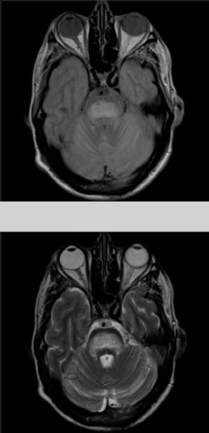 Brain MRI at admission. Proton-density/T2-weighted and FLAIR sequences showing a hyperintense lesion to the pons, presenting discrete diffusion restriction, which is suggestive of central pontine myelinolysis in the clinical context of the patient.
