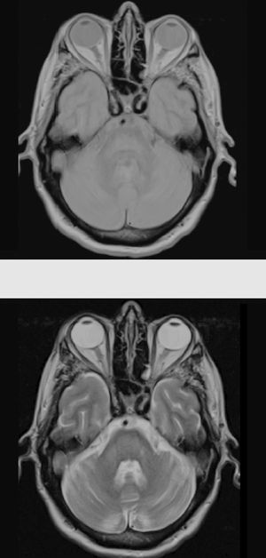 Five-month follow-up brain MRI scan showing complete resolution of symptoms. Proton-density/T2-weighted and FLAIR sequences showing altered signal intensity in the pons as a sequela of central pontine myelinolysis.