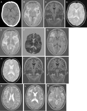 A) Head CT scan: extensive, asymmetrical, confluent hypodensities, apparently oedematous, predominantly affecting the left subcortical region. Bilateral holohemispheric pattern. Baseline brain MRI scan: B) axial T1-weighted sequence: large, confluent, bilateral holohemispheric hyperintensity involving the white matter and cortex; C) coronal T1-weighted sequence: no hippocampal atrophy; D) axial T2*-weighted sequence: few juxtacortical foci of hypointensity suggestive of brain microhaemorrhages; E) axial T2-weighted sequence: hyperintensity in the frontal operculum and bilateral temporal insular cortex extending towards the parietal region on the right and towards the medial temporo-occipital region on the left; F) ADC map: holohemispheric increased signal bilaterally. Follow-up brain MRI scan: G) axial T1-weighted sequence: bilateral fronto-termporal hyperintensity, less marked in the left hemisphere, with no insular or occipital involvement; H) axial T2*-weighted sequence: juxtacortical microhaemorrhages in the fronto-temporal region bilaterally; I-J) coronal T1-weighted sequence: medial and Sylvian temporal atrophy. Axial T2-weighted sequence: K) right holohemispheric hyperintensity of lesser extension; L) right fronto-parietal hyperintensity; M) right temporal hyperintensity.