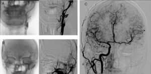 Frontal projections of brain angiography with contrast injection into the left common carotid artery, confirming occlusion of the proximal internal carotid artery (beyond carotid bifurcation) (A) and distal internal carotid artery (proximal to the ophthalmic artery) (B). C) Contrast injection into the right common carotid artery, revealing correct compensation of brain circulation through the anterior communicating artery.