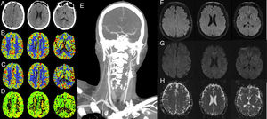 (A-E) Computed tomography: A) baseline axial CT slice showing sulcal effacement and cortical contrast uptake in the left hemisphere; B-D) CBV, CBF, and TTP maps, respectively, showing no alterations in brain perfusion, and E) coronal CT angiography slice confirming occlusion of the internal carotid artery after bifurcation, with excellent intracranial compensation. F-H) Magnetic resonance imaging: F) axial FLAIR slice; G-H) axial DWI and ADC sequences, respectively. Signal alteration is observed on the FLAIR and DWI sequences at left parietal and frontal cortex level, with no restriction on the ADC map, which is compatible with vasogenic oedema.