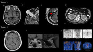 Patient 1: (A) brain MRI (gadolinium-enhanced T1-weighted sequence) showing diffuse pachymeningeal enhancement; (B) expansive right orbital lesion displacing the eye, showing homogeneous enhancement after contrast administration; (C) involvement of the acoustic-facial bundle (arrow); (D) abdominal CT scan with contrast: expansive infiltrative lesion affecting both kidneys, showing heterogeneous enhancement after contrast administration. Patient 2: (E) brain MRI (gadolinium-enhanced T1-weighted sequence) showing diffuse pachymeningeal enhancement; (F) diffuse enlargement and heterogeneous signal in the pituitary gland with pronounced homogeneous enhancement after contrast administration; (G) gallium scintigraphy: increased periaortic and interaortocaval uptake in images of the prevertebral retroperitoneum extending to the anterior part of the L4-L5 disc space.