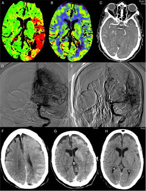 Perfusion CT (A and B): increased time to peak (A) in an extensive area of the left MCA territory, with no established ischaemia on the cerebral blood volume map (B). CT angiography (C): occlusion at the left proximal M1 segment. Angiography: occlusion at the left proximal M1 segment (D) with complete recanalisation after one pass of a Penumbra Ace® distal aspiration catheter (E). CT scan after thrombectomy (F and G): generalised contrast extravasation in the left hemisphere. CT scan at 24hours (H): signs of oedema in the left hemisphere with disappearance of the accumulated contrast and no signs of established ischaemia.