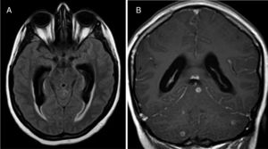Brain MRI scan. A) Axial FLAIR sequence showing communicating hydrocephalus. B) Coronal T1-weighted sequence showing meningeal gadolinium enhancement with posterior fossa tuberculomas.