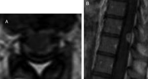 Spinal MRI scan. A) Axial section showing spinal meningeal gadolinium enhancement at the thoracic level. B) Sagittal T1-weighted sequence revealing a posterior extra-axial gadolinium-enhancing lesion at the T10 level, suggestive of abscess.