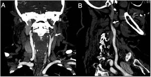 Coronal (A) and sagittal (B) CT angiography images suggestive of occlusion of the left internal carotid artery from its origin, showing the slim sign.