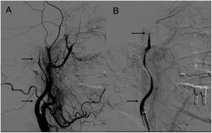 Brain angiography showing contrast flow distal to the area of carotid pseudo-occlusion, reaching the intracranial segment of the artery (A and B).
