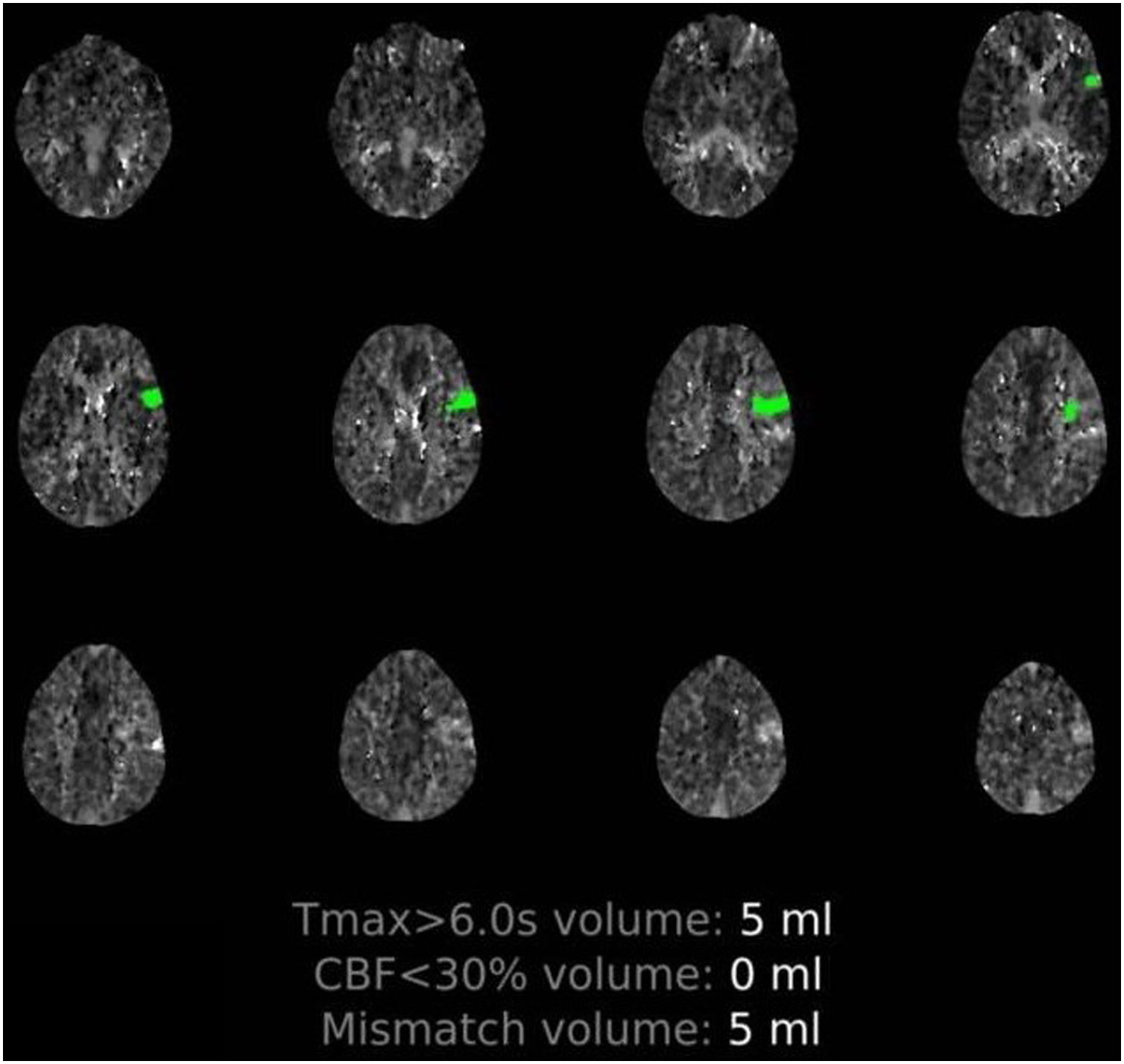 Ischaemic stroke and SARS-CoV-2 infection: a causal or incidental ...
