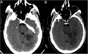 Follow-up head CT scan performed 24 h after symptom onset. (A) Infratentorial section. (B) Supratentorial section. The images reveal parenchymal hypodensities in the left cerebellar hemisphere, left occipitotemporal gyrus, and left parahippocampal gyrus.