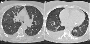 Chest CT scan at admission. (A) Axial plane at the level of the upper lobes. (B) Axial plane at the level of the lower lobes. Bilateral ground-glass opacities, predominantly on the right side, affecting the central and mainly the peripheral area. The scan also revealed consolidation in the right upper lobe and moderate right pleural effusion.