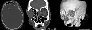 Head CT scan of the first patient showing metallic artefacts compatible with bird shot and loss of bone continuity at the left frontal sinus.
