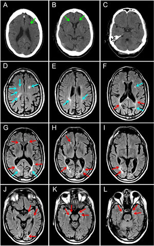 Neuroimaging studies at onset and during patient follow-up. A–C) A head CT study performed at clinical onset (without contrast): non-specific, poorly-defined subcortical hypodense lesions in the periventricular region of both brain hemispheres and in the anterior part of the left frontal lobe (green arrows), probably related to demyelination plaques (patient previously diagnosed with MS). Study revealed no evidence of acute intracranial pathology. Unfortunately, the radiological procedure was suspended, as it was not possible to obtain a neuroimaging sequence using an iodinated contrast medium due to the psychomotor agitation of the patient in the context of a probable allergic reaction to the iodinated medium. D–L) A brain MRI study performed at 3 months (axial FLAIR sequence): images show at least 30 supratentorial hyperintense lesions (red and blue arrows). Some lesions present an ovoid morphology and others are confluent with irregular, poorly-defined borders, which is compatible with MS plaques with sharp edges. The majority of lesions are grouped around the periventricular regions (red arrows), especially in the deep white matter surrounding the temporal horns of the lateral ventricles (J–L). No contrast uptake was observed on T1-weighted sequences. No lesions were found in other regions, including all the spinal cord segments. CT: computed tomography; FLAIR: fluid-attenuated inversion recovery; MRI: magnetic resonance imaging; MS: multiple sclerosis.