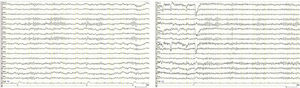EEG traces obtained before and after onset of insulin therapy. The first trace shows asymmetrical alpha activity, which is absent in the second.