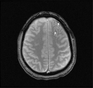T2-weighted brain MRI scan showing haemosiderin deposits (arrows) in the sulci of the left frontal convexity, corresponding to cSAH.