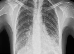 Chest radiography: bilateral ground-glass opacities, predominantly affecting the lung bases.