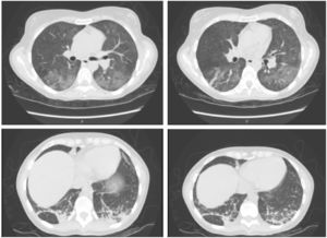 Pulmonary high-resolution computed tomography: infiltrate predominating in both lung bases and left basal pneumonia.