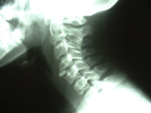 Cervical/thoracic spine radiography, lateral view. Calcifications in the nucleus pulposus of intervertebral discs C4-C5, C7-T1, T2-T3, and T5-T6. Enlarged intervertebral disc space at C4-C5, with greater soft tissue thickness at that level.