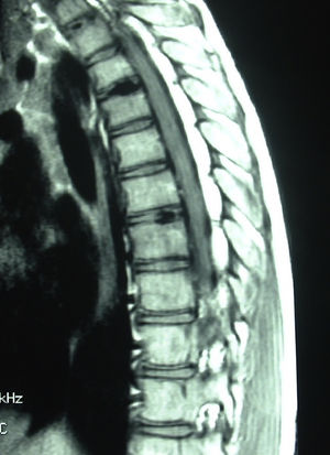 MRI scan of the cervical and thoracic spine, sagittal section. Calcifications in the nucleus pulposus of intervertebral discs C4-C5, T1-T2, T3-T4, and T6-T7.