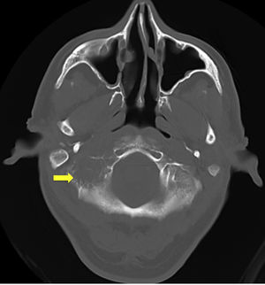 Head CT bone window study without intravenous contrast; axial plane. A spiculated, destructive lytic lesion (arrow) is observed on the right occipital squama and condyle, projecting toward the skull base.
