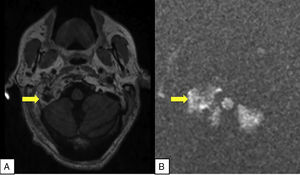A) Axial T1-weighted MRI scan with intravenous contrast. The lytic lesion presents heterogeneous contrast uptake on the occipital condyle and skull base (arrow). B) Axial diffusion-weighted MRI sequence showing considerable restriction (arrow).