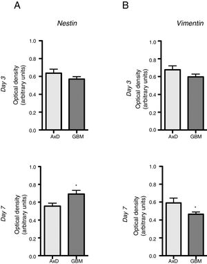 Nestin and vimentin expression in transfected and GBM cells. Both cell types showed similar levels of nestin and vimentin expression at day 3 of differentiation; differences in marker expression were observed at day 7. These findings reflect transfected cells attempting to compensate for altered differentiation, and confirm the glial nature of GBM cells. Graphs show means and standard error. *P<.05. GBM: glioblastoma multiforme.
