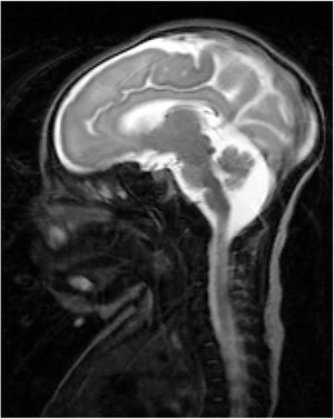 Magnetic resonance imaging scan revealing LCH.
