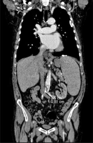Aortic CT angiography. Occlusion of the abdominal aorta and both illiac arteries.