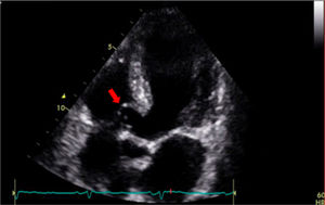 Transthoracic echocardiogram showing a membranous interventricular septal aneurysm (arrow).