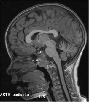 Brain MRI: sagittal sequence showing moderate cerebellar atrophy.