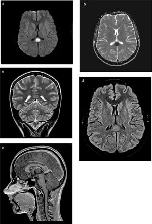 MRI study. Ovoid tumefactive lesion located in the splenium of the corpus callosum, with diffusion restriction. A) Axial diffusion-weighted imaging at b1000; B) axial diffusion-weighted sequence with ADC mapping; C) coronal T2-weighted sequence; D) axial T2-weighted FLAIR sequence; (E) sagittal gadolinium-enhanced T1-weighted sequence.