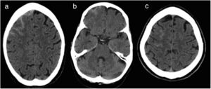 Non-contrast CT scans of patient 1 (A), patient 2 (B), and patient 3 (C). All scans show right frontal cSAH.