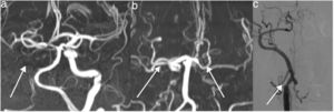 A) MR angiography of patient 1 showing occlusion of the right common carotid artery (arrow). B) MR angiography of patient 2 showing bilateral occlusion of the ICA (arrows). C) MR angiography of patient 3 showing occlusion of the right ICA (arrow).