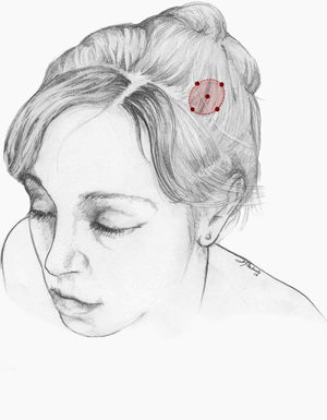 Area of injection in patients with nummular headache. The number of injection sites and the dose of onabotA depend on the size of the symptomatic area.