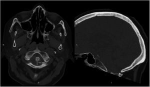 Head CT scan (bone window): axial and sagittal planes. Both images show a posterior atlantodental interval <13mm (white line).