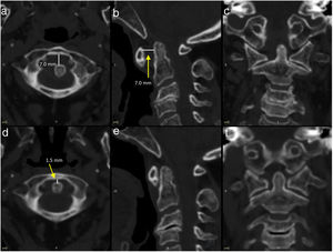 Non-contrast neck CT images taken before (a–c) and after (d–f) cervical spine immobilisation with a Halo vest. The neuroimaging study performed before the intervention revealed an abnormal anterior atlantodental interval (>3mm, a and b), which was subsequently corrected (d and e).