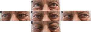 A) Upward gaze with no alterations. B) Rightward gaze, with partial abduction of the right eye. C) Primary position, with bilateral esotropia. D) Leftward gaze, with mildly impaired abduction of the left eye. E) Downward gaze, with mild right eye esotropia. Preserved convergence (not shown). Examination performed after 14 days of treatment, with partial improvement, mainly of the left abducens nerve (increased contrast uptake on MRI). Diplopia persisted.