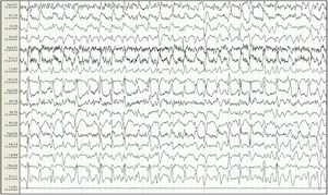 Baseline electroencephalography (international 10-20 system, longitudinal montage). Attenuation of background activity, which is substituted by diffuse epileptiform discharges predominantly in the right frontal and central areas, appearing persistently throughout the reading; this is compatible with status epilepticus. Lack of signal from the Cz-Pz derivation for technical reasons.