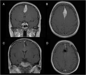 Patient 1: T1-weighted MRI scan with contrast administration. A and B) Preoperative images of recurrent tumour (patient recently admitted to hospital). C and D) Postoperative follow-up images.