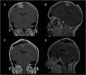 Patient 2: T1-weighted MRI scan with contrast administration. A and B) Preoperative images of recurrent tumour (patient recently admitted to hospital). C and D) Postoperative follow-up images.