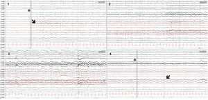 Surface electroencephalography: epileptiform activity during one of the seizures. Electrodes were placed according to the international 10-20 system. Monopolar recording (AV: average); sensitivity: 10 mV; high-frequency filter: 70 Hz; 30-s epochs. The recording shows 4 epochs: seizure onset (epoch 1, asterisk and vertical line), with fast rhythmic activity in the right centroparietal region and midline (C4-P4-Cz; epoch 1, arrow), which increases in amplitude and propagates to adjacent derivations, leading to slow, regular, rhythmic activity (theta/alpha waves), with sharp waves in frontotemporal regions, predominantly on the right side (epochs 2 and 3), until seizure resolution (epoch 4, asterisk and vertical line), and postictal slowing in the right centrotemporal region (epoch 4, arrow).
